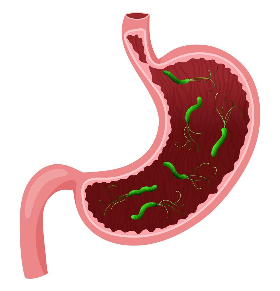 Helicobacter pylori en estómago vacío. ilustración vectorial, estilo de dibujos animados, fondo blanco vector