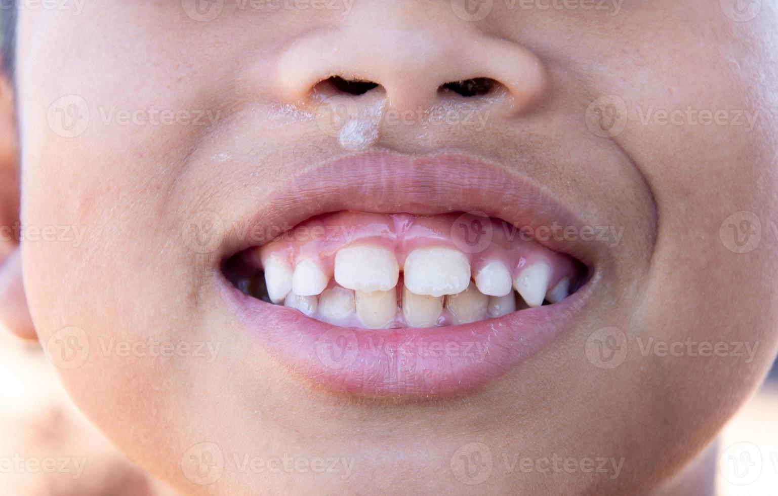 The child's mouth is smiling, showing teeth, having a runny nose, having a cold. photo