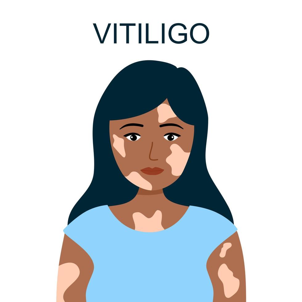 vitíligo enfermedad de la piel concepto vector ilustración. mujer con problema de piel.