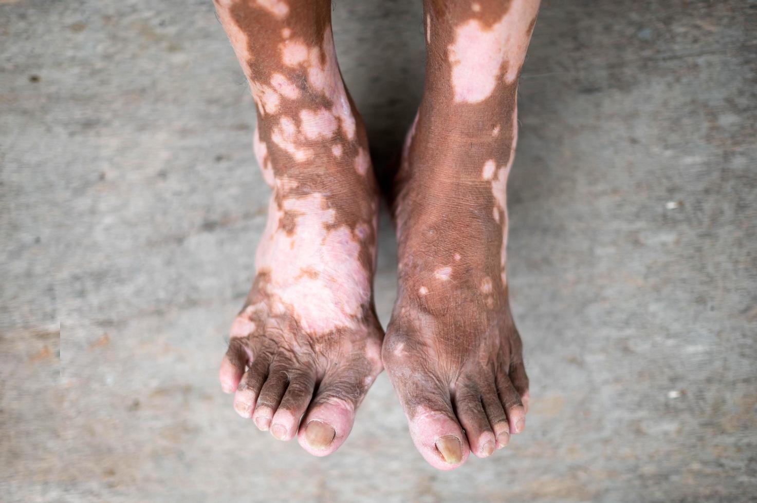 The old man leg with skin condition that causes loss of melanin posing indoors. The foot model in black tank top suffering from vitiligo disorder. photo