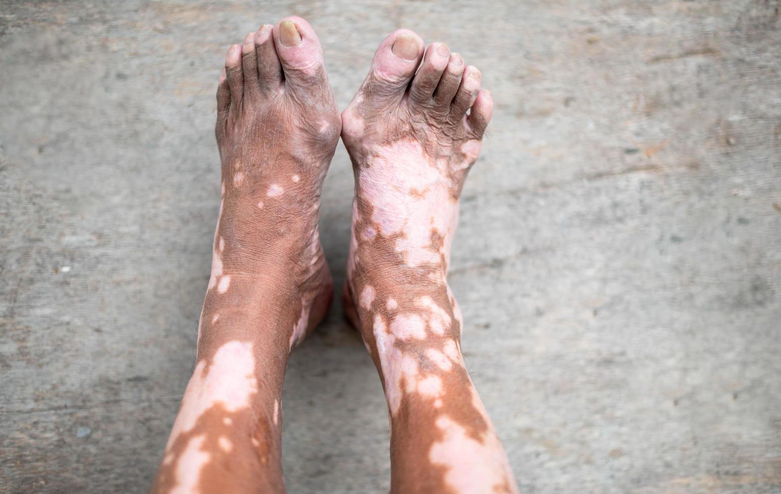The old man leg with skin condition that causes loss of melanin posing indoors. The foot model in black tank top suffering from vitiligo disorder. photo