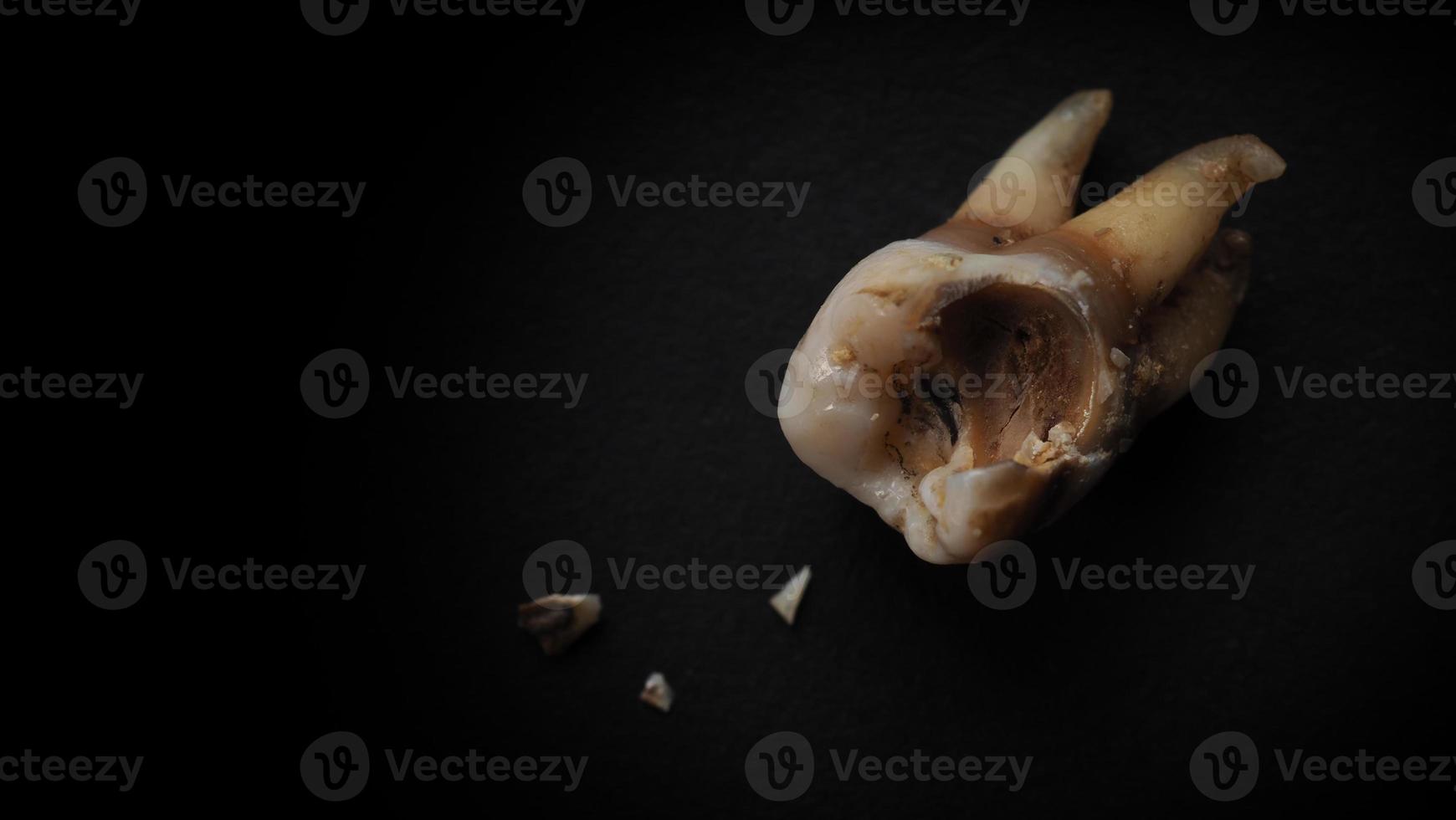 Macro shot of a decayed teeth till root after extraction of dentist. photo