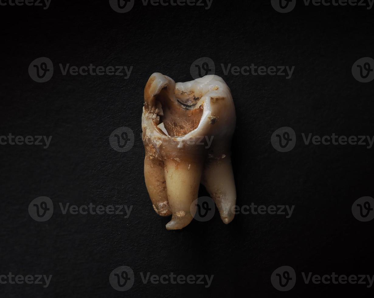Macro shot of a decayed teeth till root after extraction of dentist. photo
