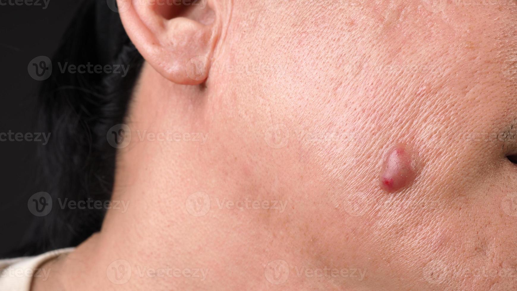 Big Acne Cyst Abscess or Ulcer Swollen area within face skin tissue. photo