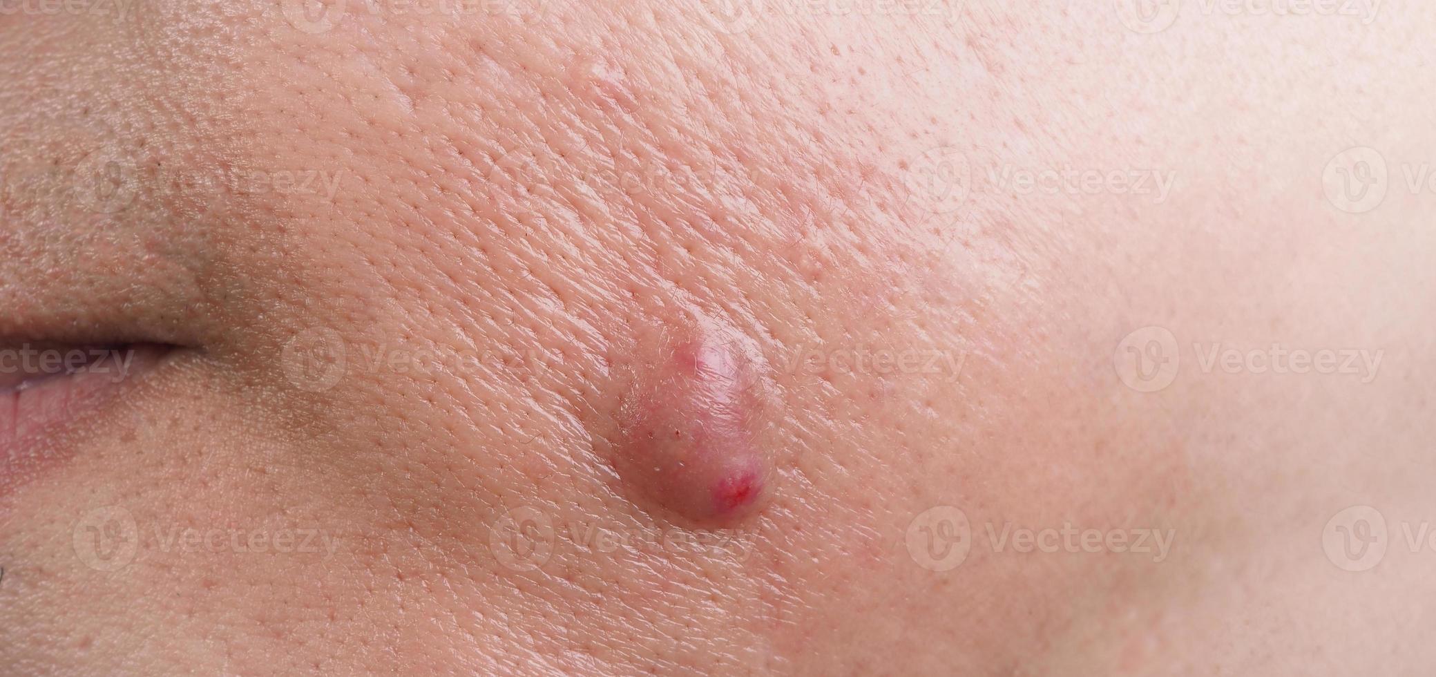 Big Acne Cyst Abscess or Ulcer Swollen area within face skin tissue. photo