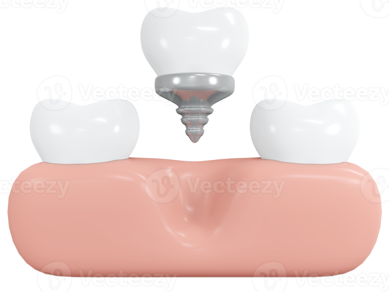 3D Rendering teeth with implant with gum tool icon cartoon style. 3D Render illustration. png