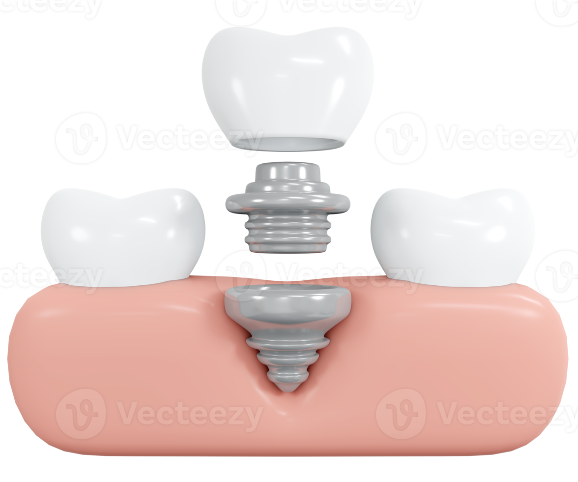 Dents de rendu 3d avec implant avec style de dessin animé d'icône d'outil de gomme. illustration de rendu 3d. png