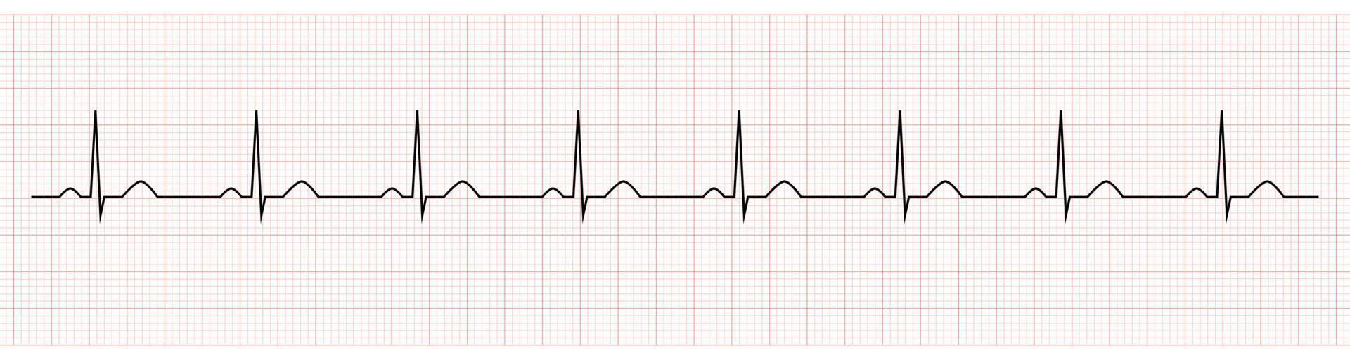 EKG showing normal sinus rhythm of patient vector