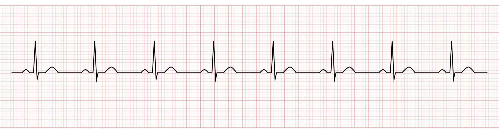 electrocardiograma que muestra el ritmo sinusal normal del paciente vector