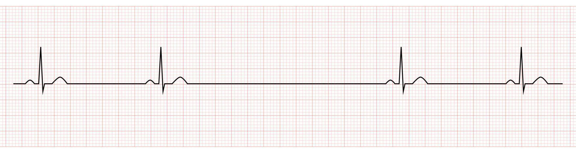 EKG Showing Sinus Bradycardia with pause of Patient vector