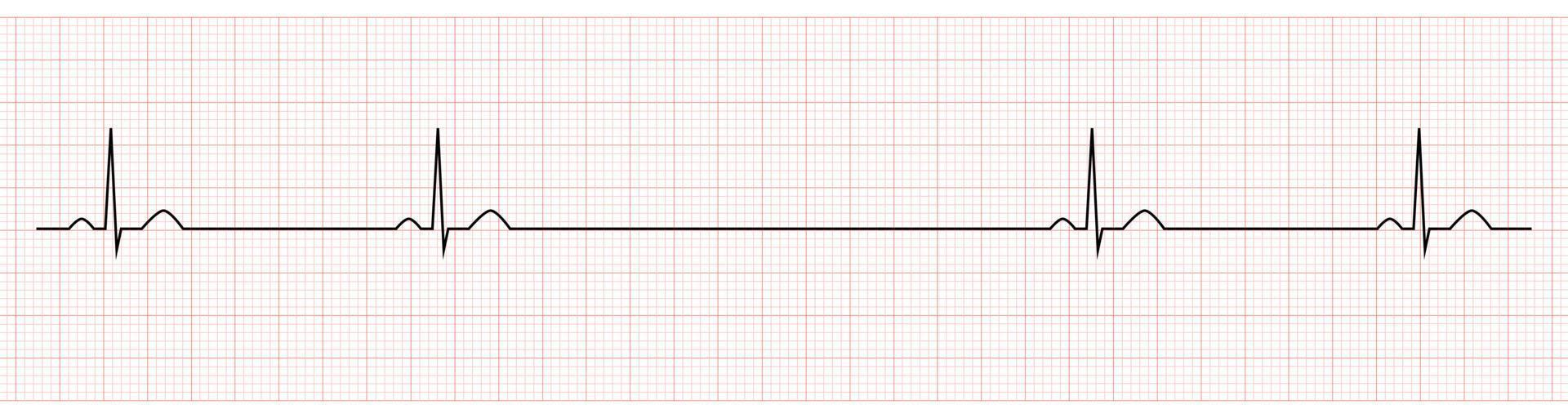 EKG Showing Sinus Bradycardia with pause of Patient vector