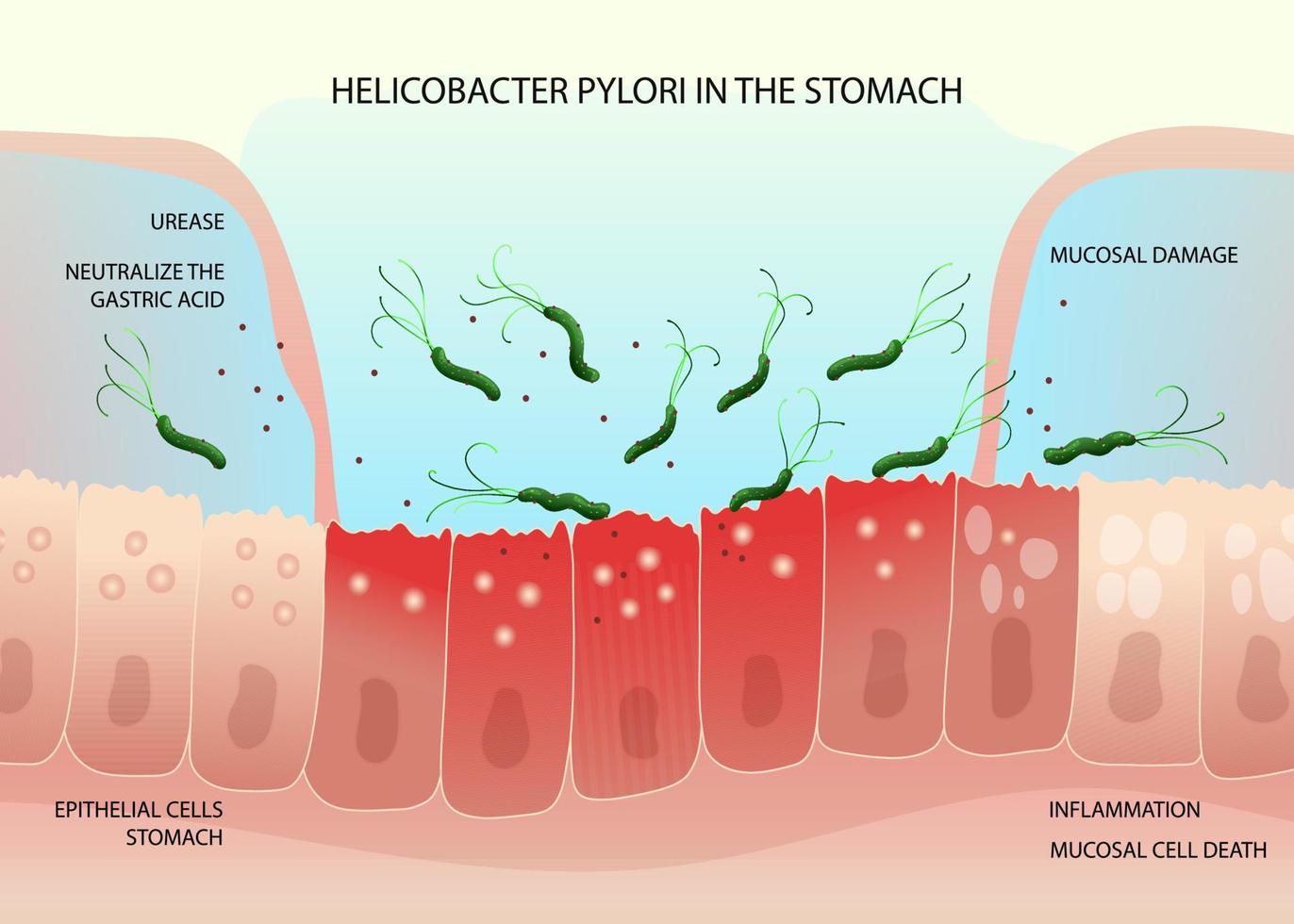 Helicobacter pylori bacteria on inflamed epithelial cells in human stomach vector