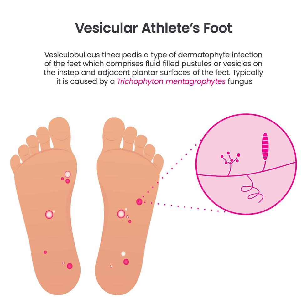 infografía vectorial educativa del pie de atleta vesicular vector