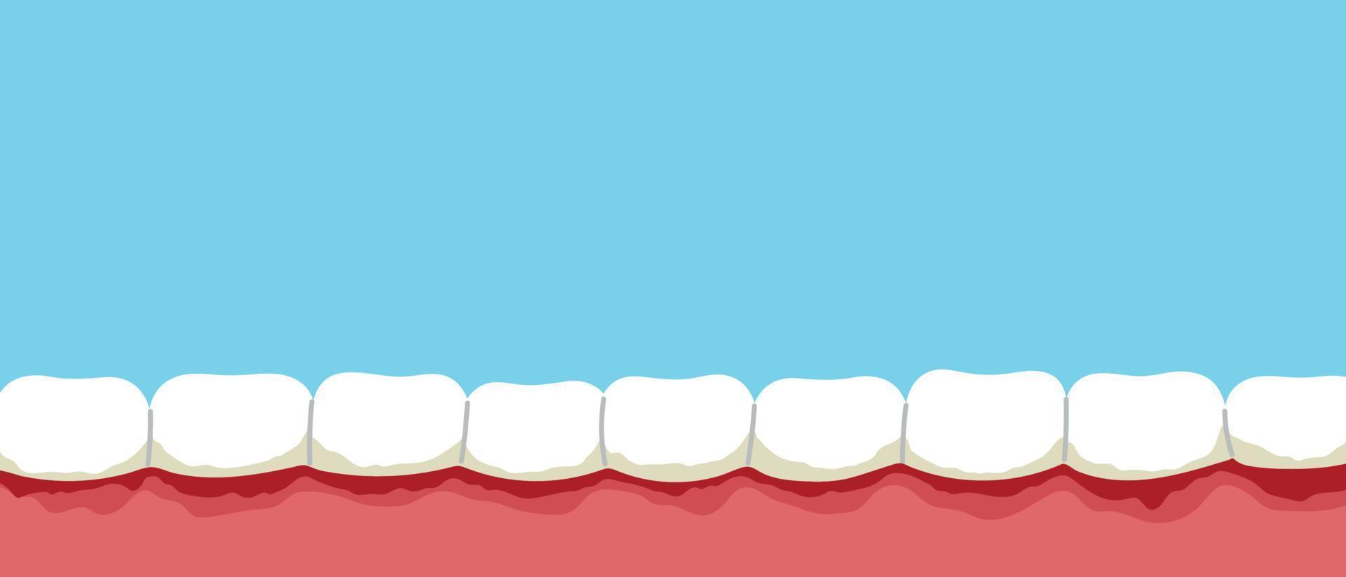 Gum disease cartoon banner. Periodontitis, gum bleeding, plaque on the teeth. Flat vector isolated illustration
