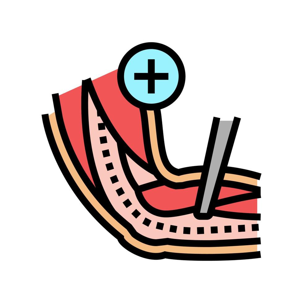 ulnar nerve release color icon vector illustration