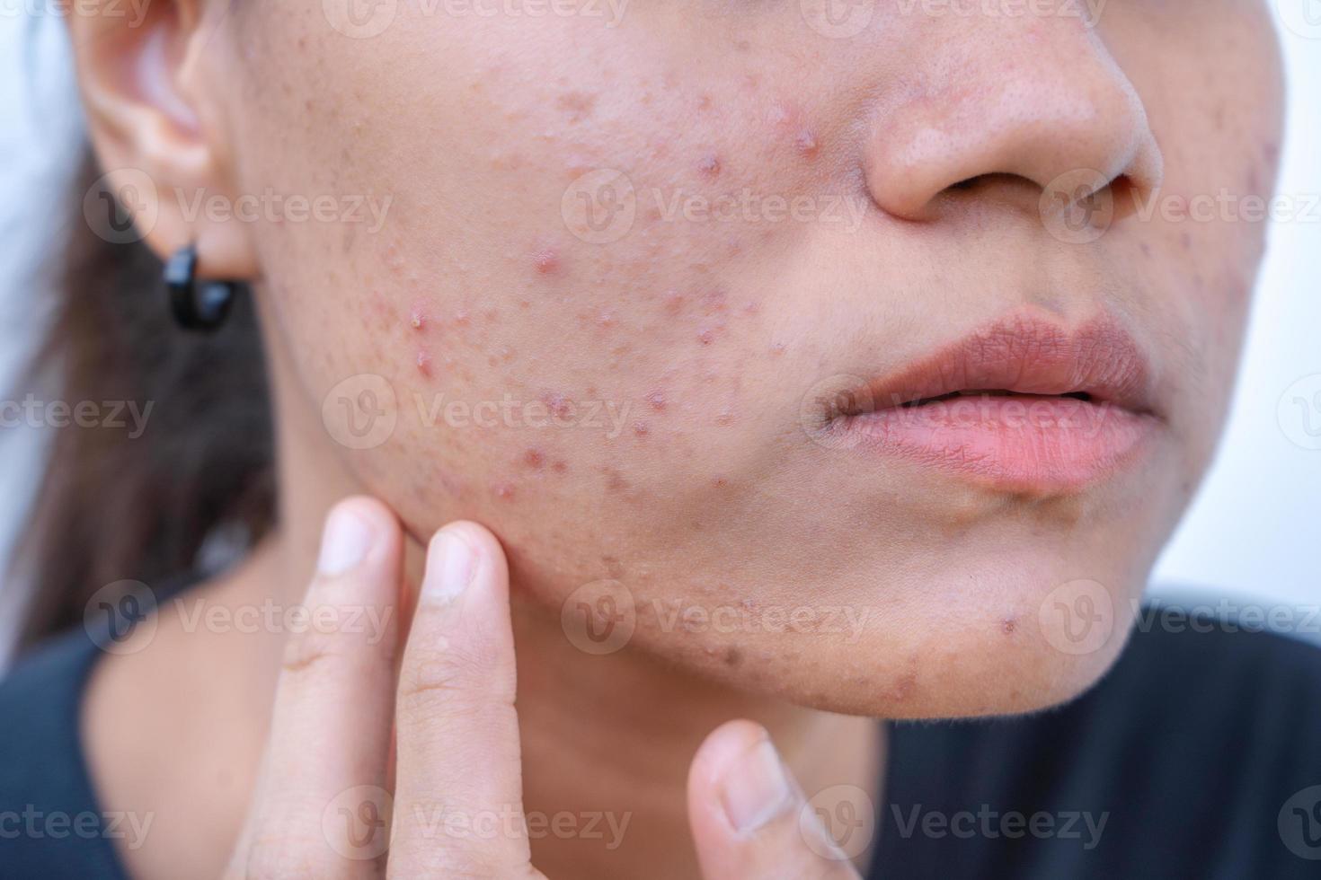 el primer plano de una joven asiática se preocupa por su cara cuando tiene problemas con la piel de la cara. problemas con el acné y la cicatriz en la piel femenina. problema de cuidado de la piel y concepto de salud. foto