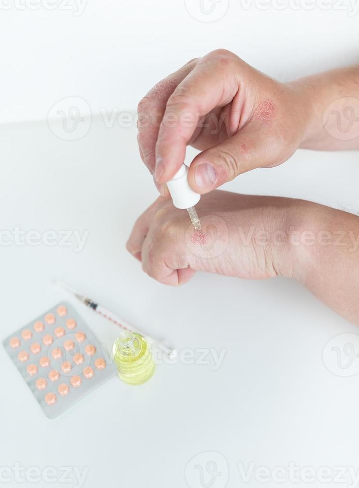 A man spreads healing gel on his hands. Causes of itchy skin can be dermatitis eczema, dry skin, burns, food allergies. healthcare concept. photo
