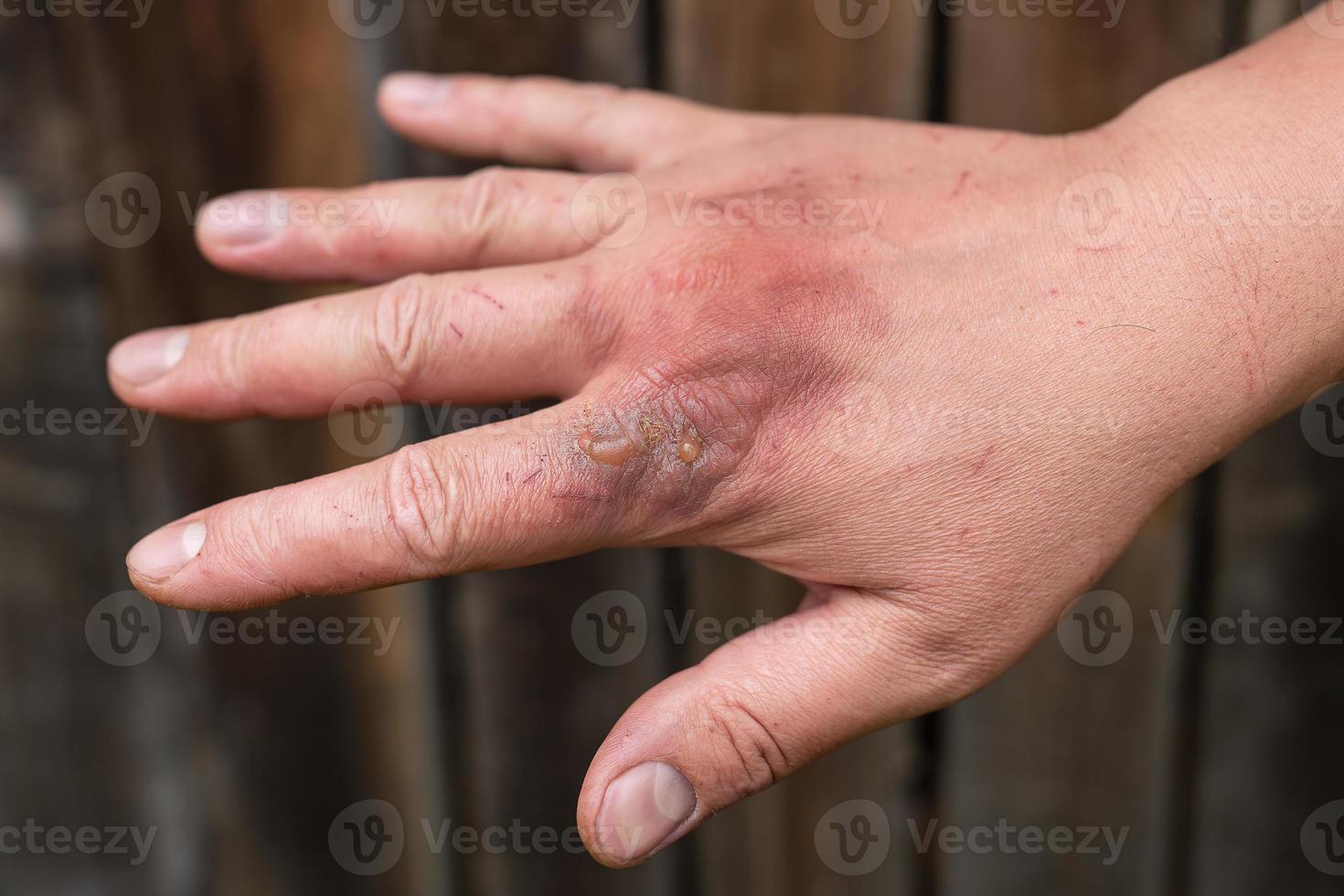First degree skin burn. Hand burns, wounds. Hot boiling water acts on the skin. Fresh burn. photo