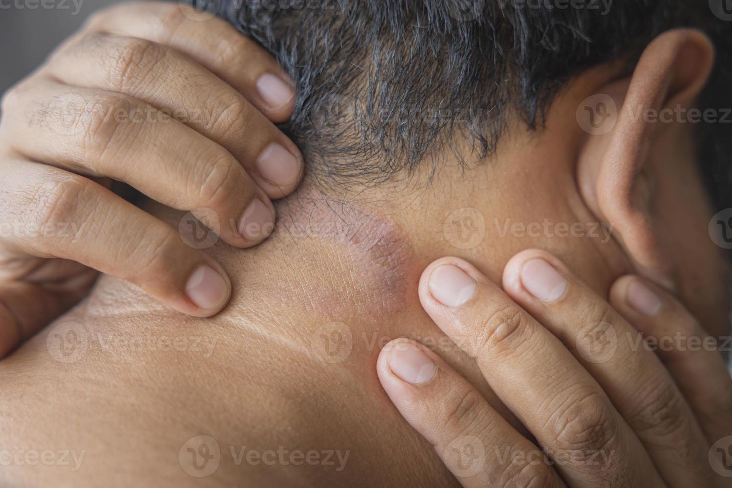 Dark-skinned Asian men suffer from scalp dermatitis due to moisture-causing fungi. fungal itching. skin diseases-allergies, psoriasis, eczema, dermatitis. photo