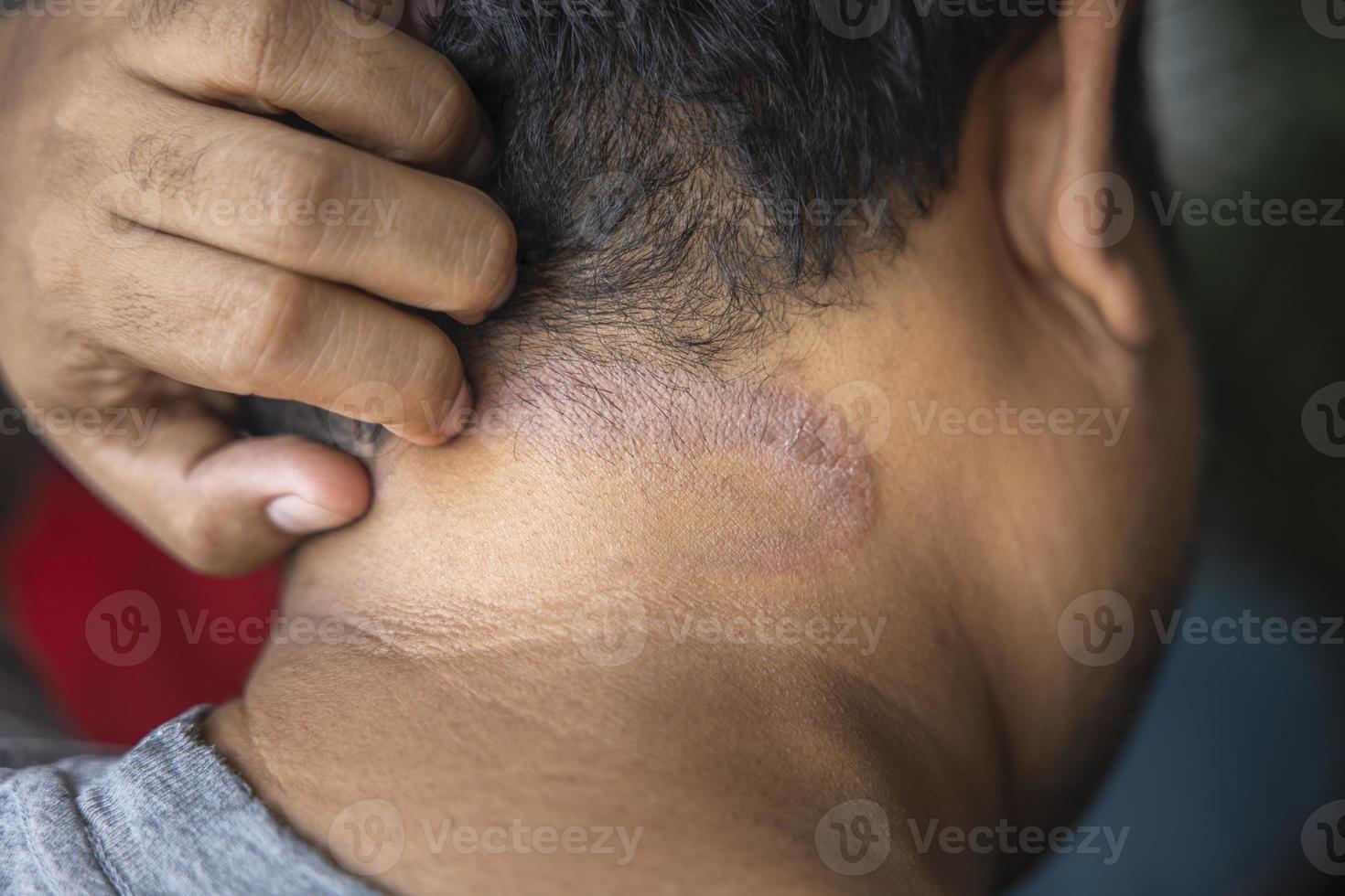Dark-skinned Asian men suffer from scalp dermatitis due to moisture-causing fungi. fungal itching. skin diseases-allergies, psoriasis, eczema, dermatitis. photo