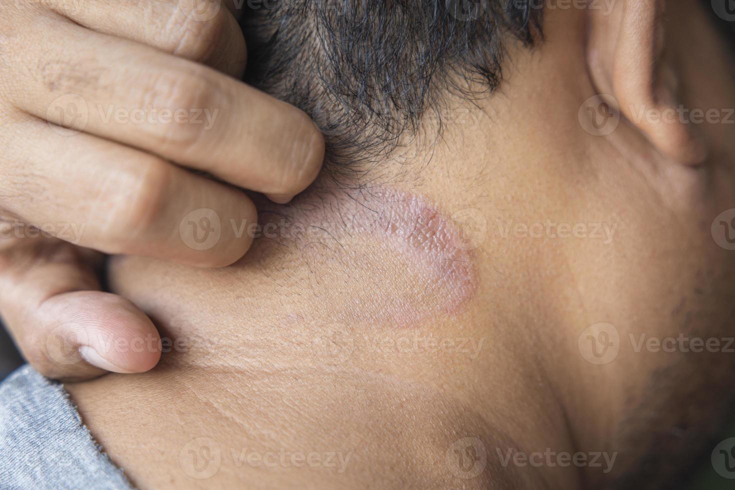 Los hombres asiáticos de piel oscura sufren de dermatitis en el cuero cabelludo debido a los hongos que causan la humedad. picor fúngico. enfermedades de la piel-alergias, psoriasis, eczema, dermatitis. foto