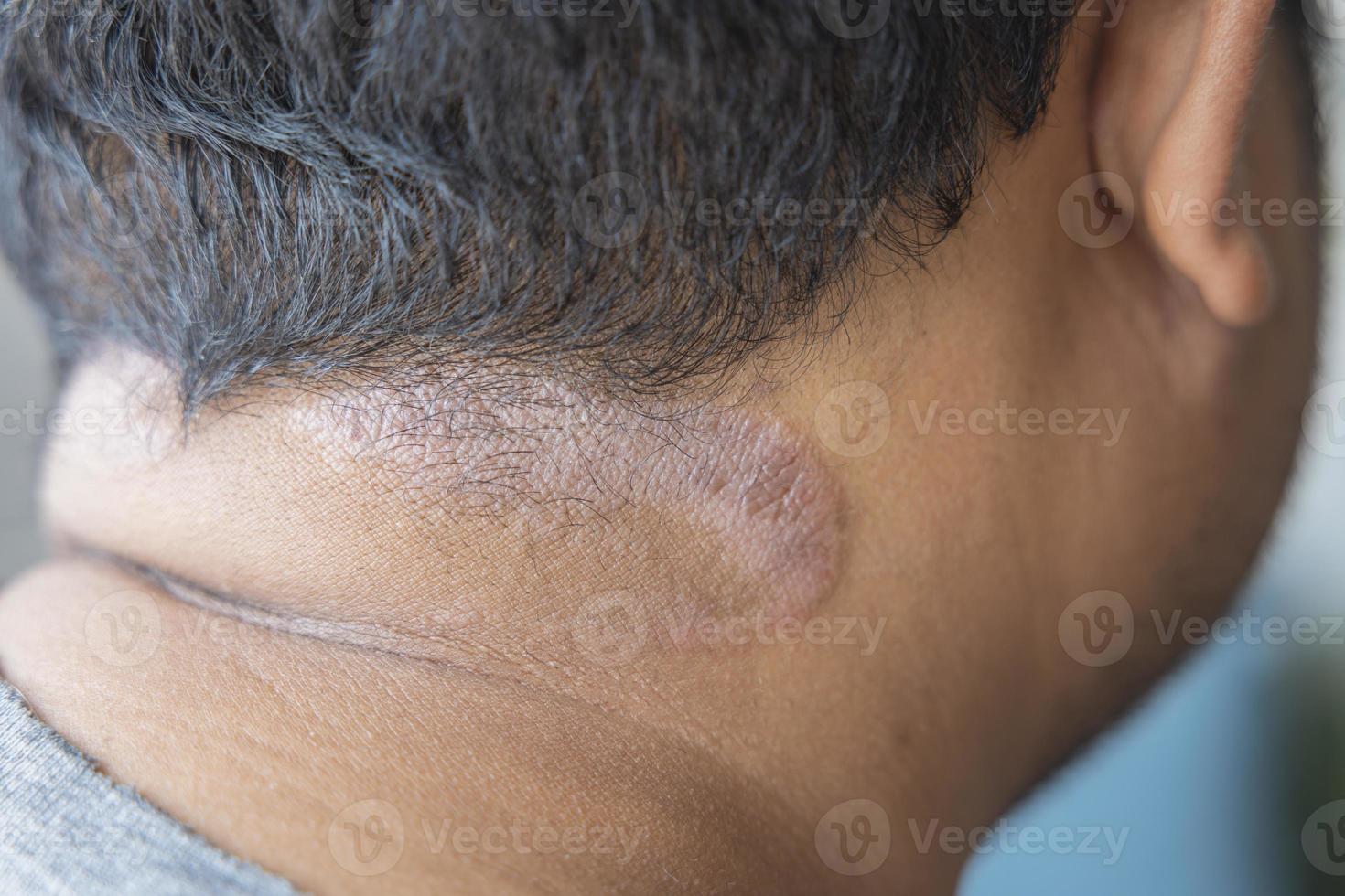 Dark-skinned Asian men suffer from scalp dermatitis due to moisture-causing fungi. fungal itching. skin diseases-allergies, psoriasis, eczema, dermatitis. photo