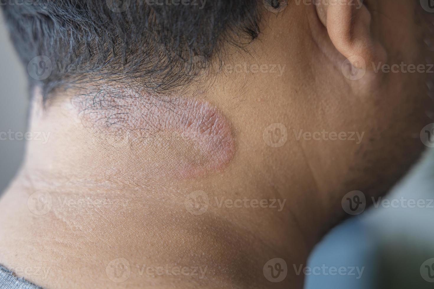 Dark-skinned Asian men suffer from scalp dermatitis due to moisture-causing fungi. fungal itching. skin diseases-allergies, psoriasis, eczema, dermatitis. photo