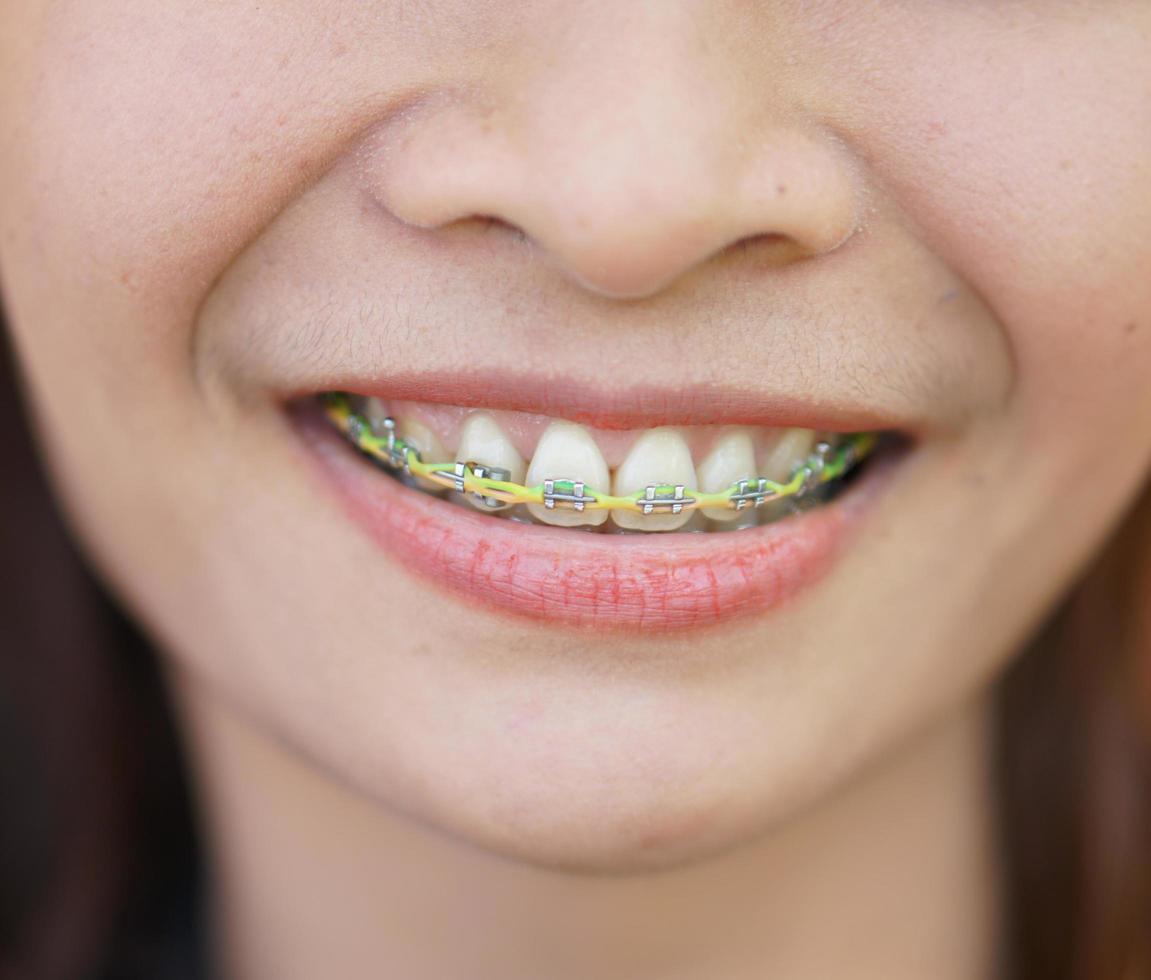 Yellow braces in woman's mouth photo