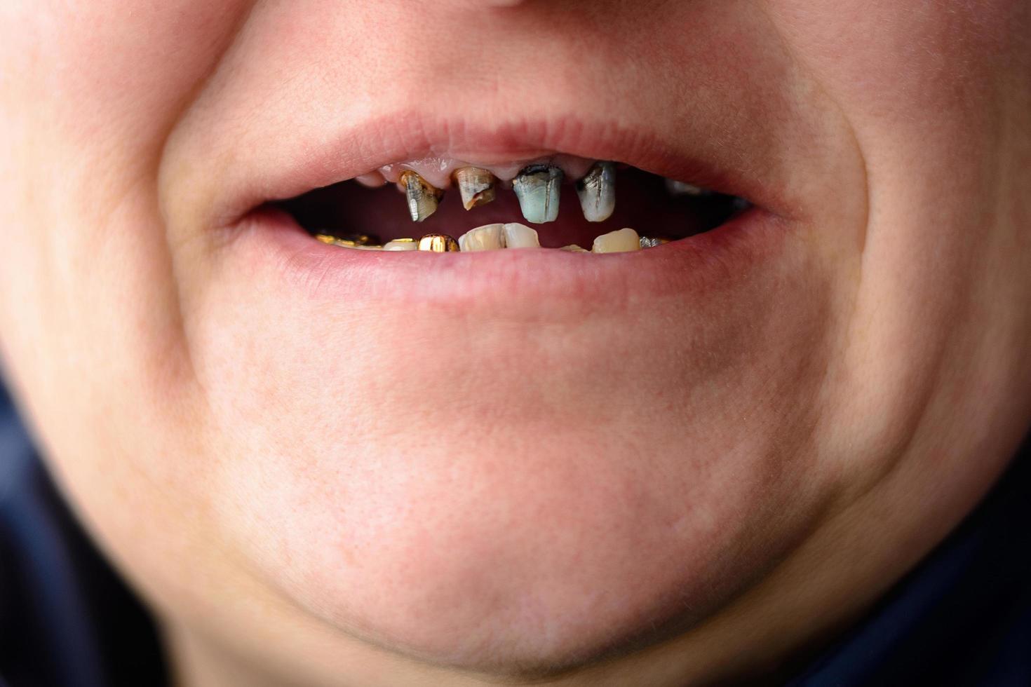 Close-up of a woman's face with rotten and dying teeth photo