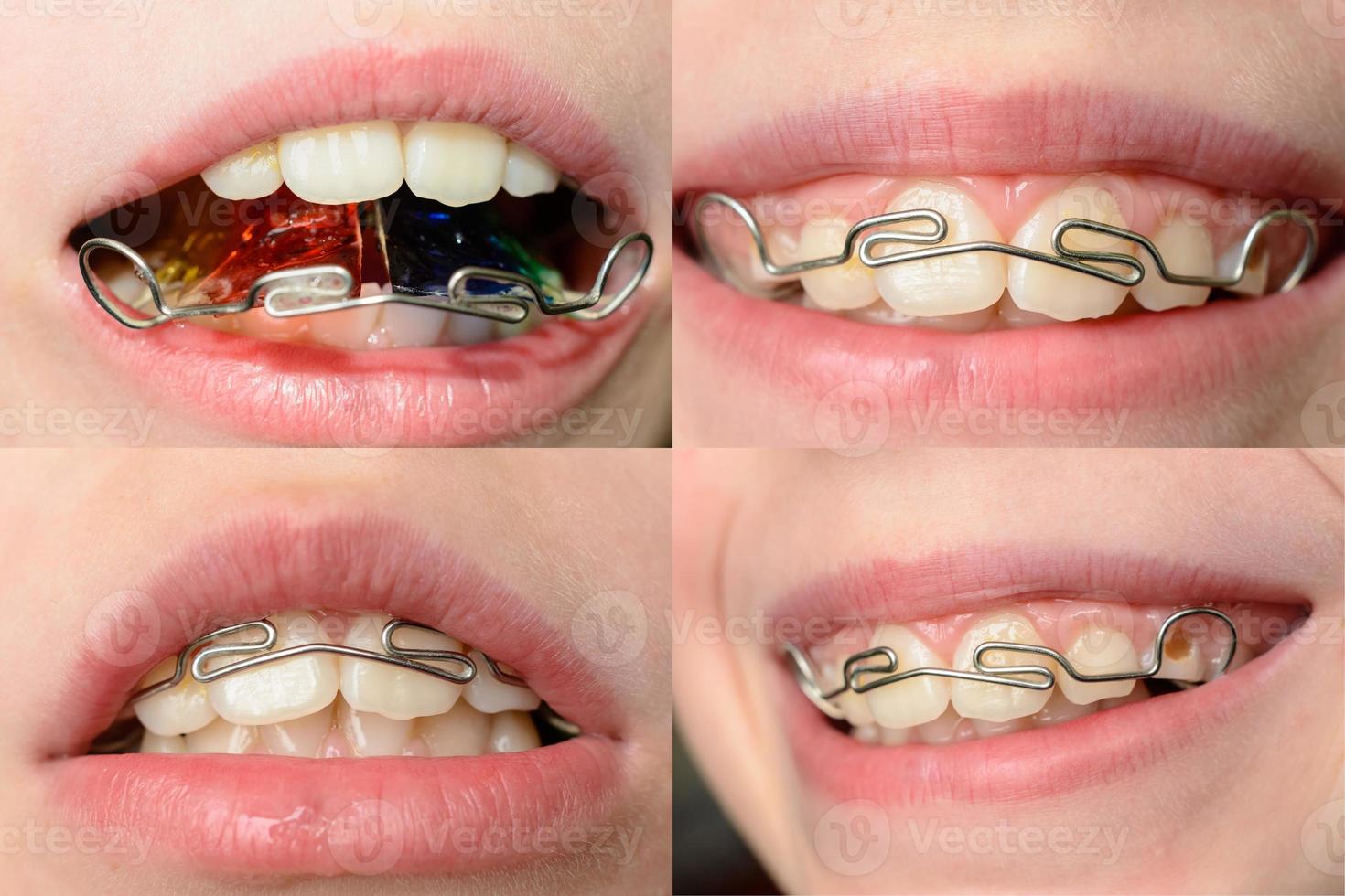 Close-up mouth of crooked teeth with braces Toothbrush in the mouth of the adolescent photo