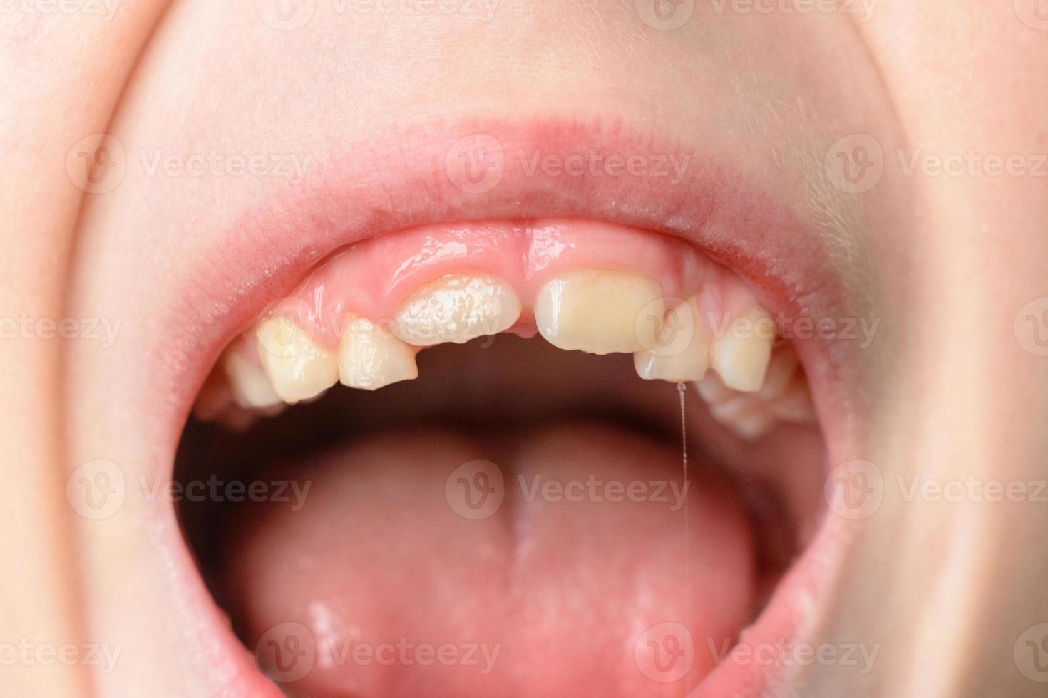 el niño abre bocas anchas, mostrando sus dientes torcidos después de caerse los dientes de leche foto