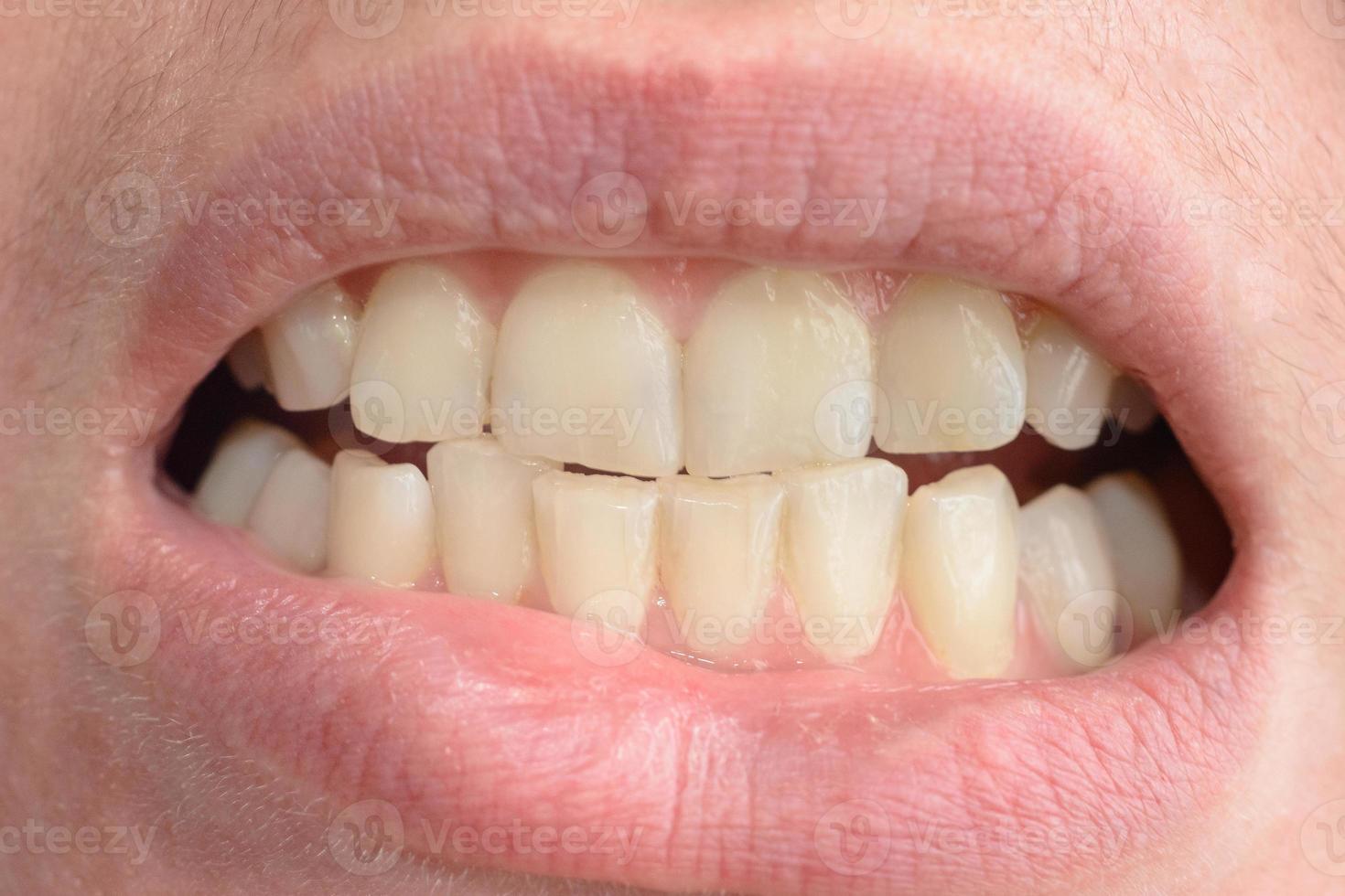 A young woman shows her crooked teeth that needs medical help in close-ups photo