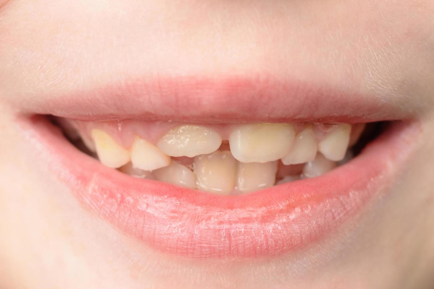 Close-up of a small boy with curved teeth smiling photo