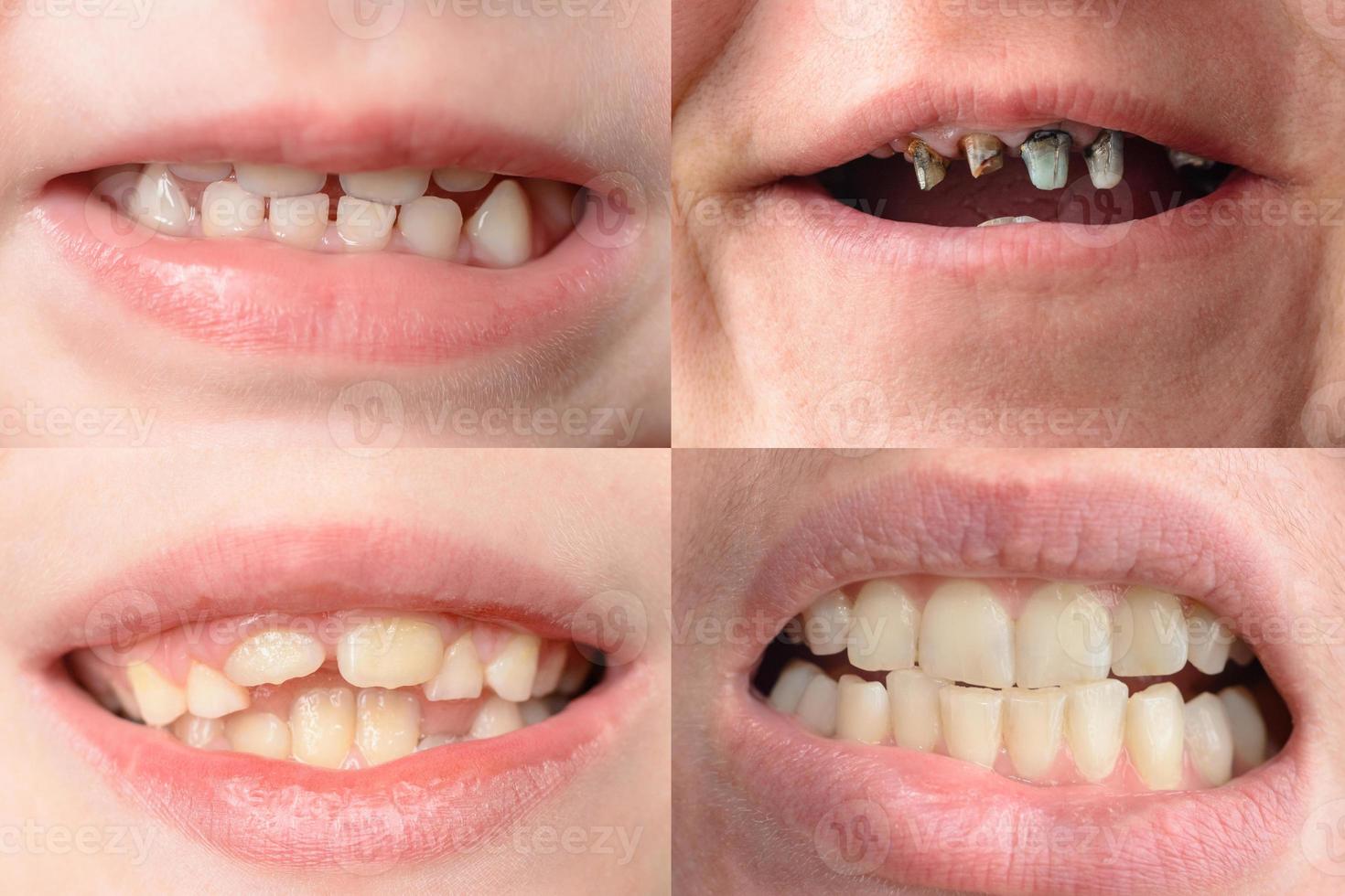 A set of four photographs of people with curves and rotten teeth photo