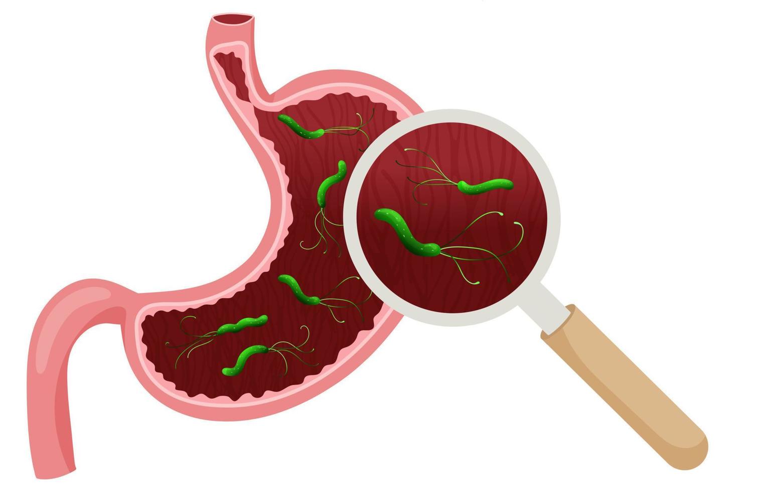 Helicobacter pylori in empty stomach under magnifying glass. Vector illustration, cartoon style