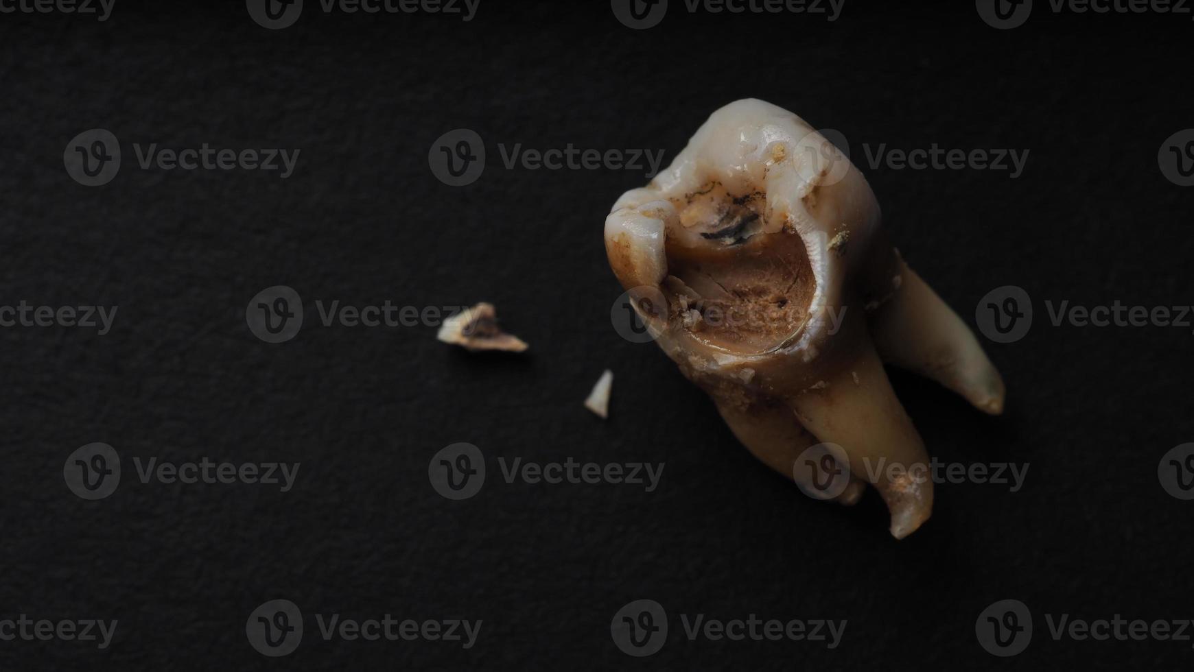 Macro shot of a decayed teeth till root after extraction of dentist. photo