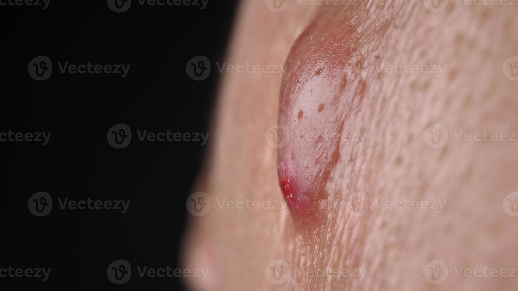 Big Acne Cyst Abscess or Ulcer Swollen area within face skin tissue. photo