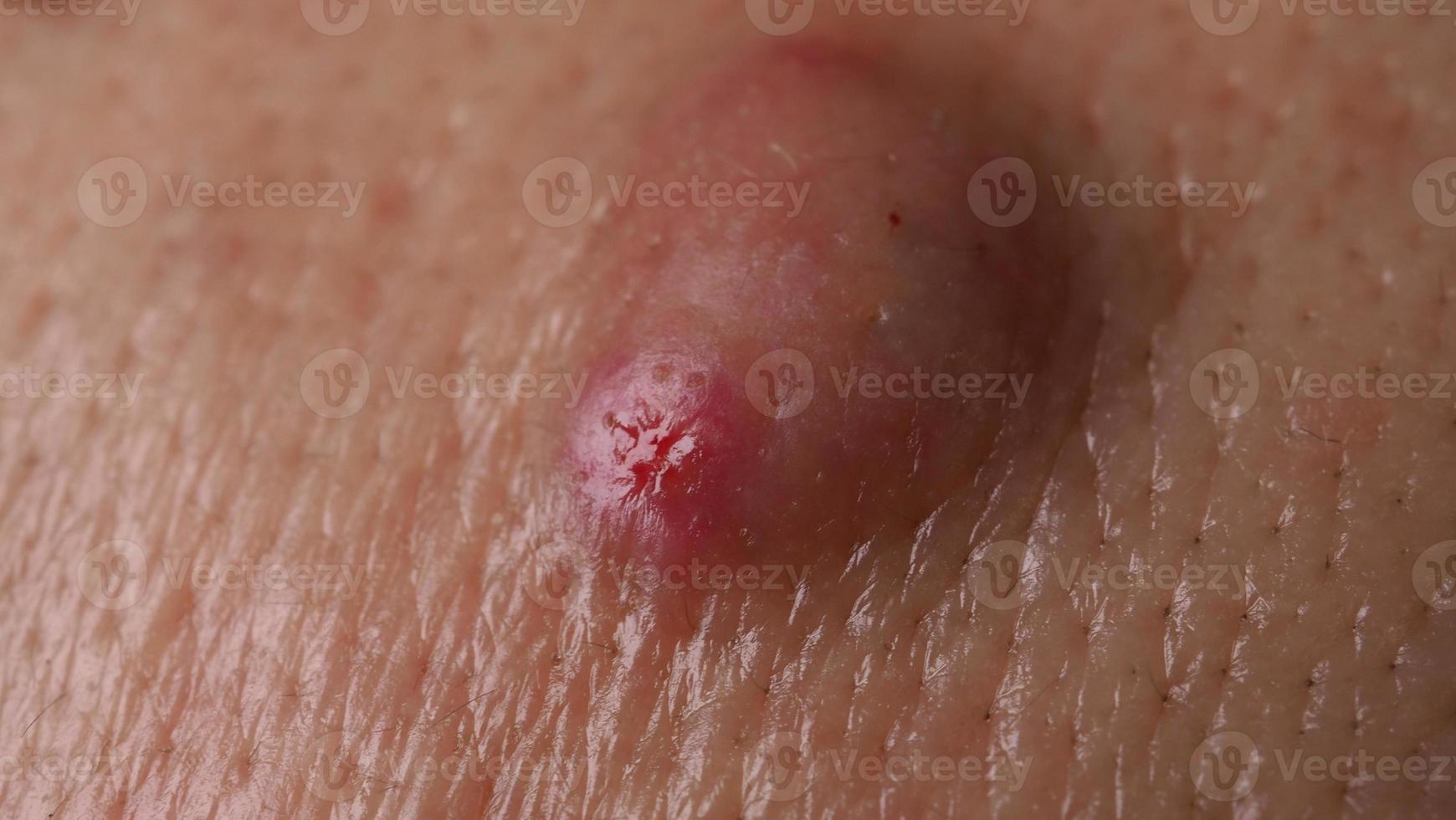 Big Acne Cyst Abscess or Ulcer Swollen area within face skin tissue. photo