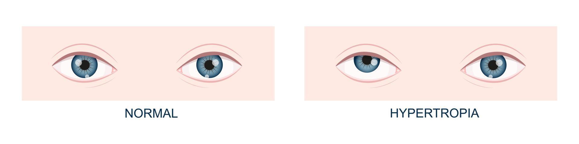 Hypertropia. Vertical strabismus before and after surgery. Human eyes healthy and with upward gaze position. Double vision vector