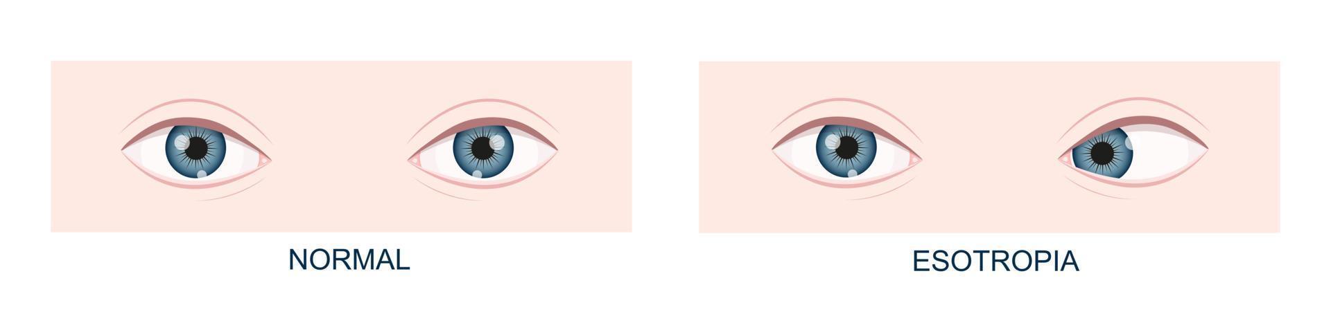 Esotropia. Horizontal strabismus before and after surgery. Eye misalignment, cross-eyed condition. Human eyes healthy and with inward gaze position. Double vision vector