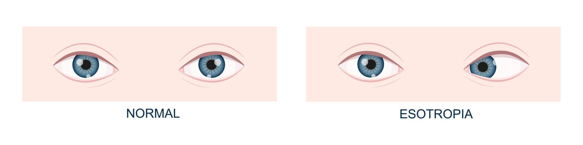 Esotropia. Horizontal strabismus before and after surgery. Eye misalignment, cross-eyed condition. Human eyes healthy and with inward gaze position. Double vision vector