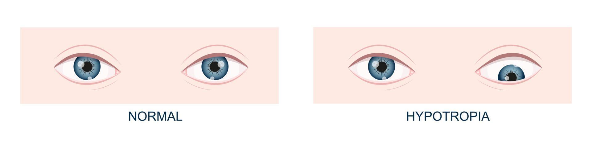 Hypotropia. Vertical strabismus. Human eyes healthy and with downward gaze position. Double vision vector