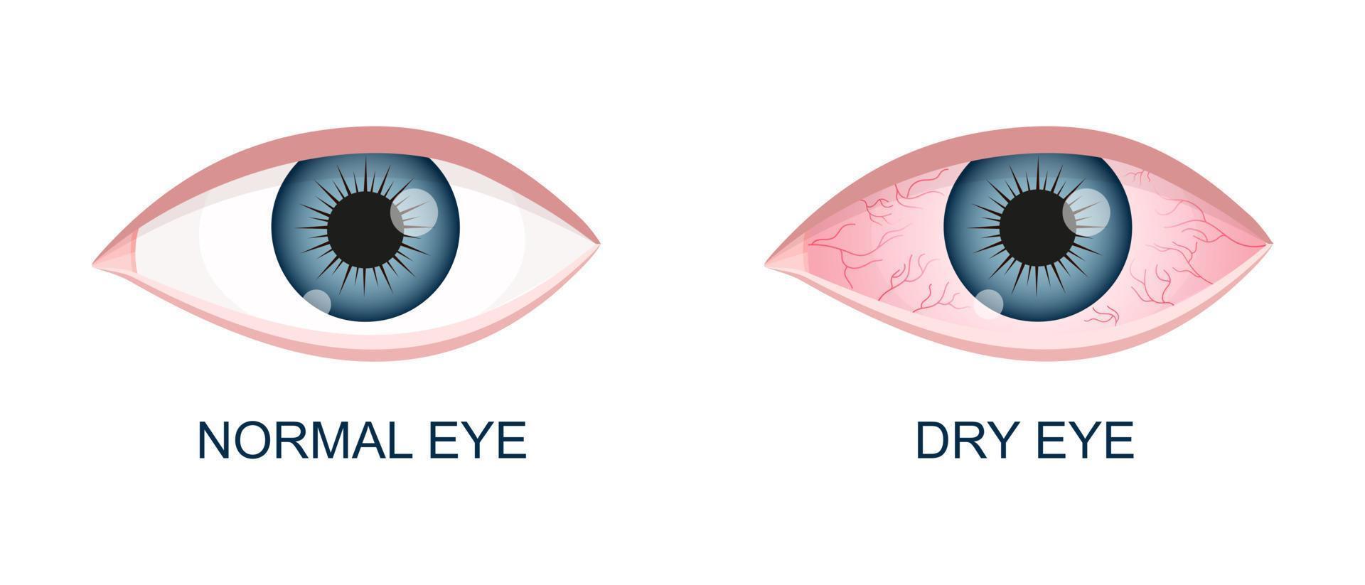 ojo humano sano y seco. globo ocular inyectado en sangre normal e inflamado con irritación y conjuntiva roja. síntomas de queratitis, alergia, conjuntivitis, uveítis vector