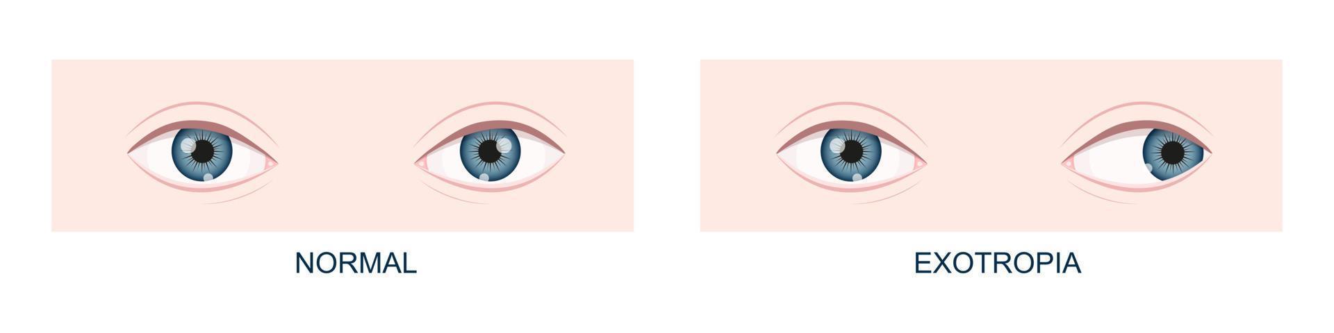 Exotropia. Horizontal strabismus before and after surgery. Eye misalignment, cross-eyed condition. Human eyes healthy and with outward gaze position. Double vision vector