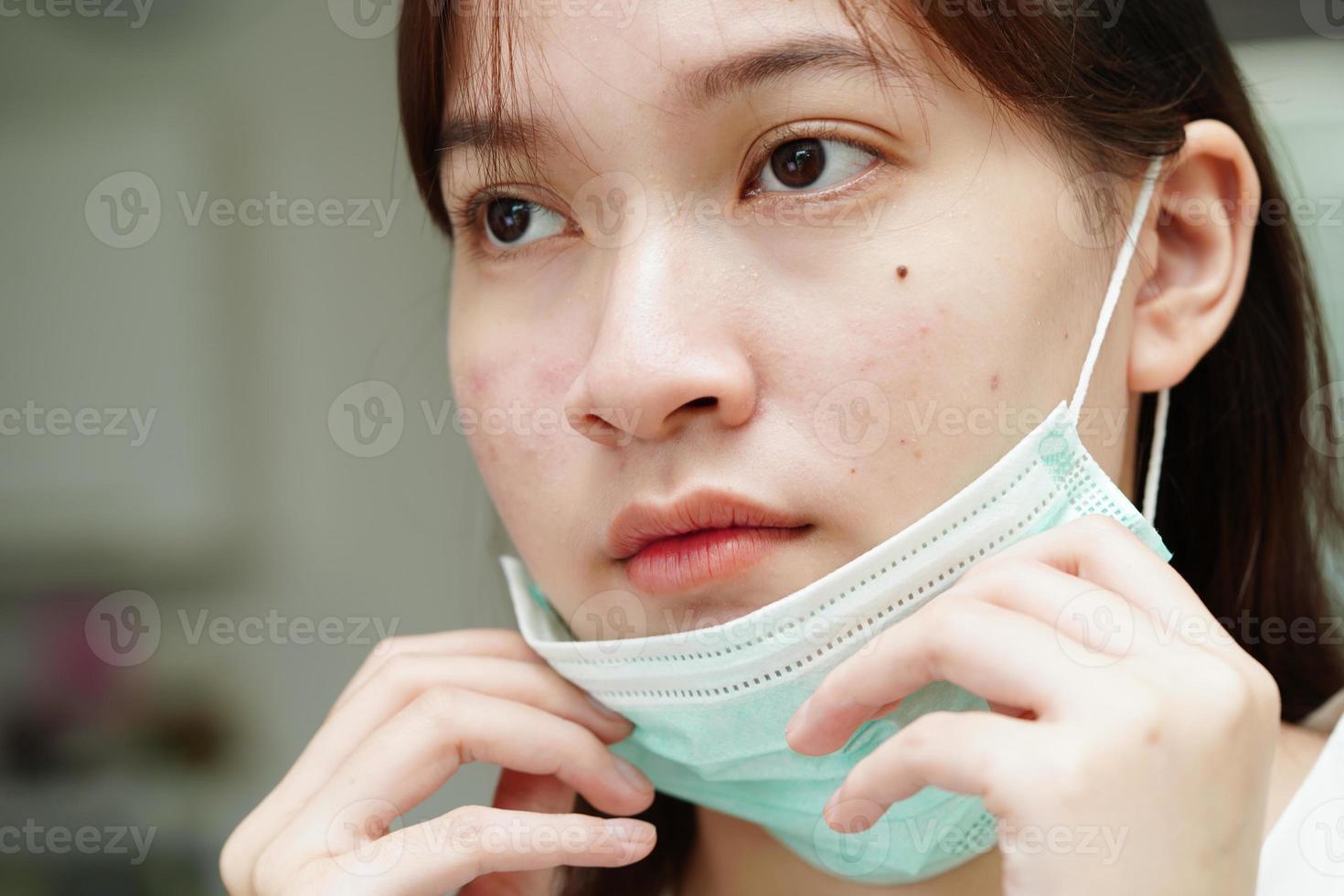 Acne pimple and scar on skin face, disorders of sebaceous glands, teenage girl skincare beauty problem. photo