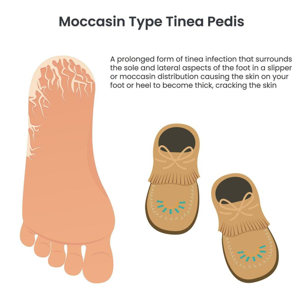 Moccasin type tinea pedis athlete's food education vector infographic