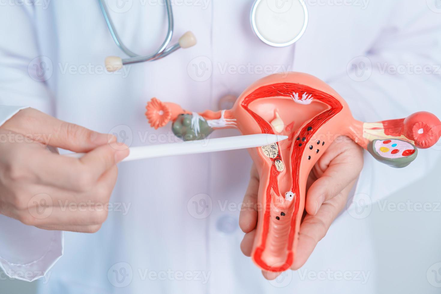 doctor sosteniendo modelo de útero y ovarios. cáncer de ovario y de cuello uterino, trastorno del cuello uterino, endometriosis, histerectomía, fibromas uterinos, sistema reproductivo y concepto de embarazo foto