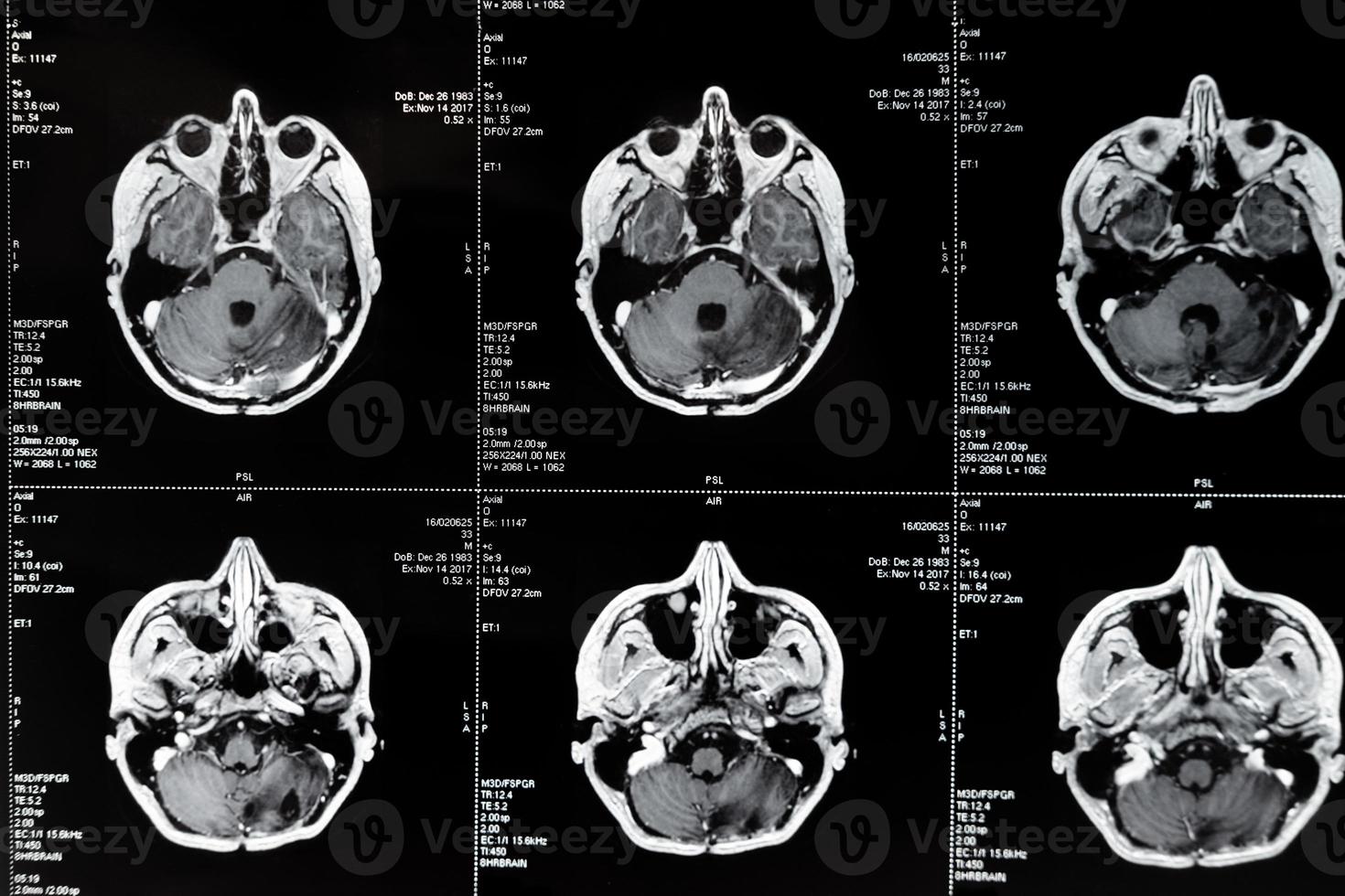 mri con tumor cerebral. imagen de resonancia magnética. foto