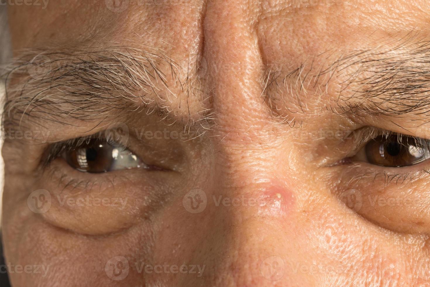 Man with a pimple on the bridge of his nose photo