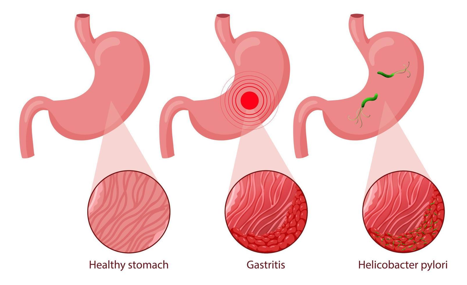 Human stomach illustration, healthy, with helicobacter and with gastritis vector